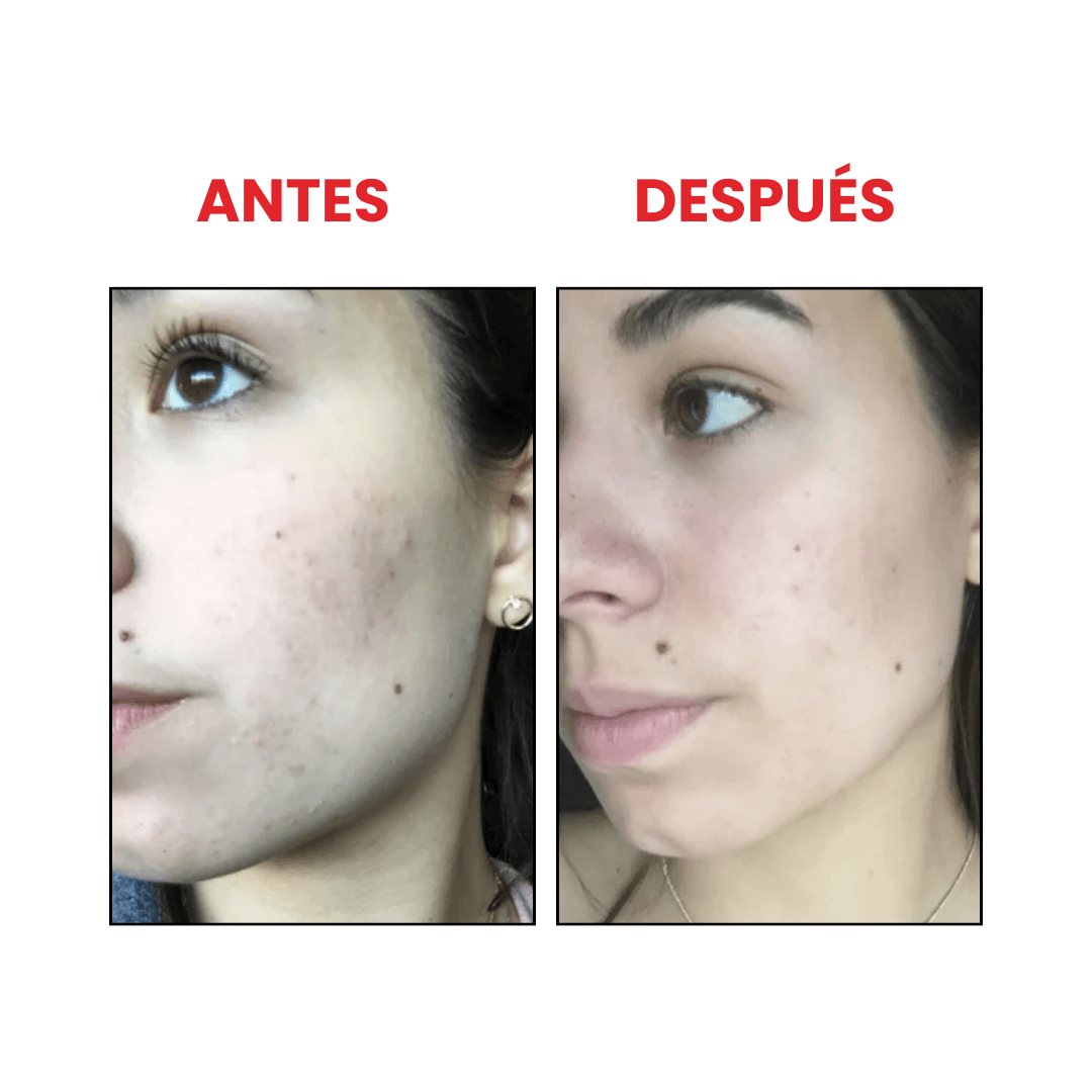AHA 30% + BHA 2% Peeling solution