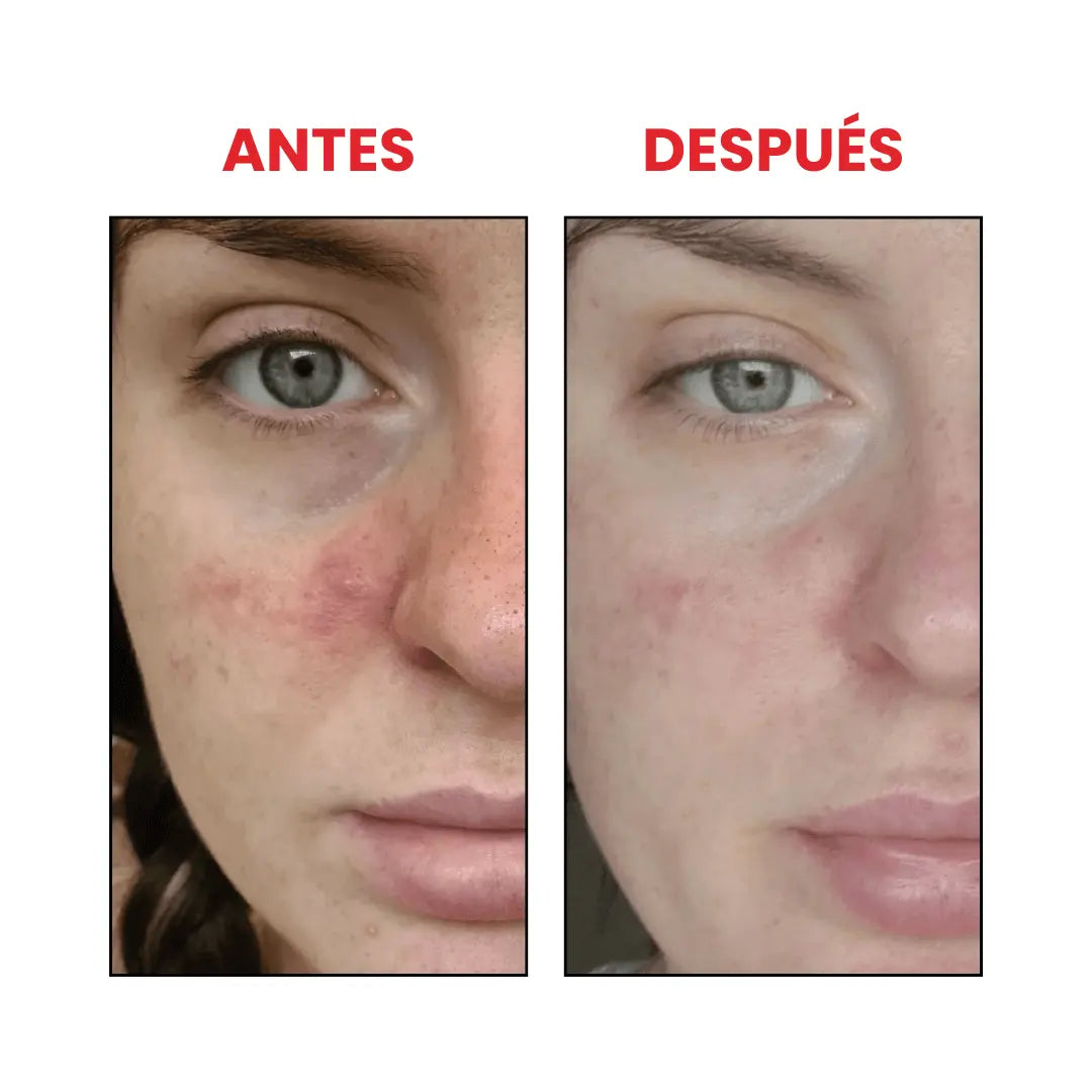 Azelaic Acid 10% Suspension The Ordinary que disminuye puntos negros.