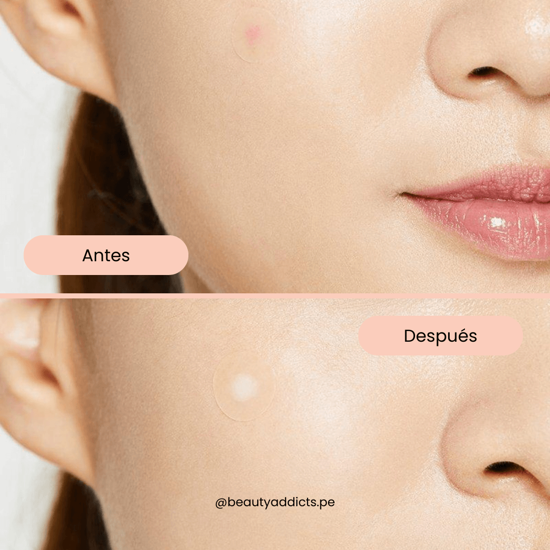 COSRX Acne Pimple Patch para reducir inflamación nocturna.
