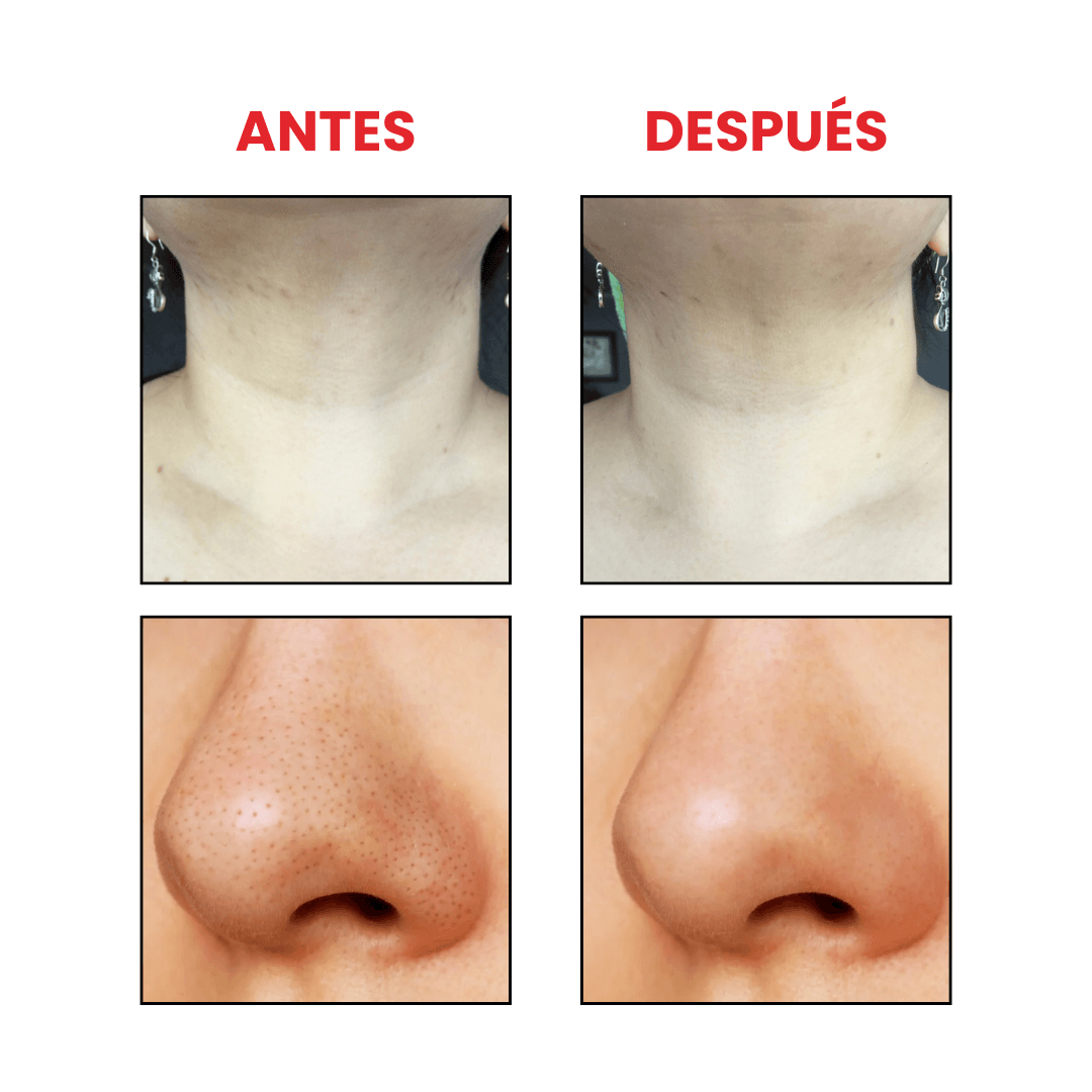 Exfoliante BHA Blackhead Power Liquid