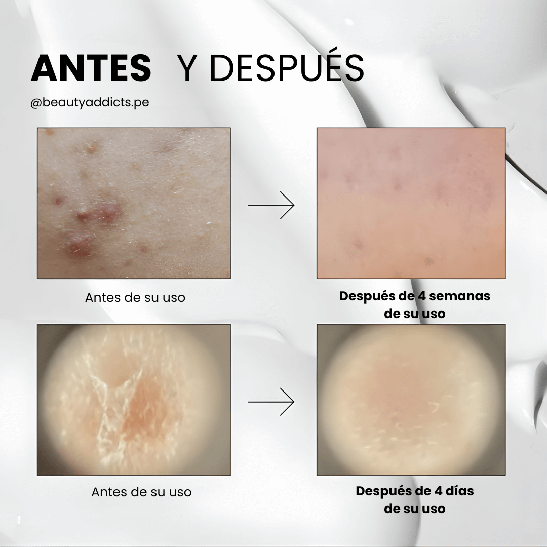 Mild Reedle Shot 50 VT Cosmetics reduce la apariencia de micro‑relieves y marcas recientes de acné.