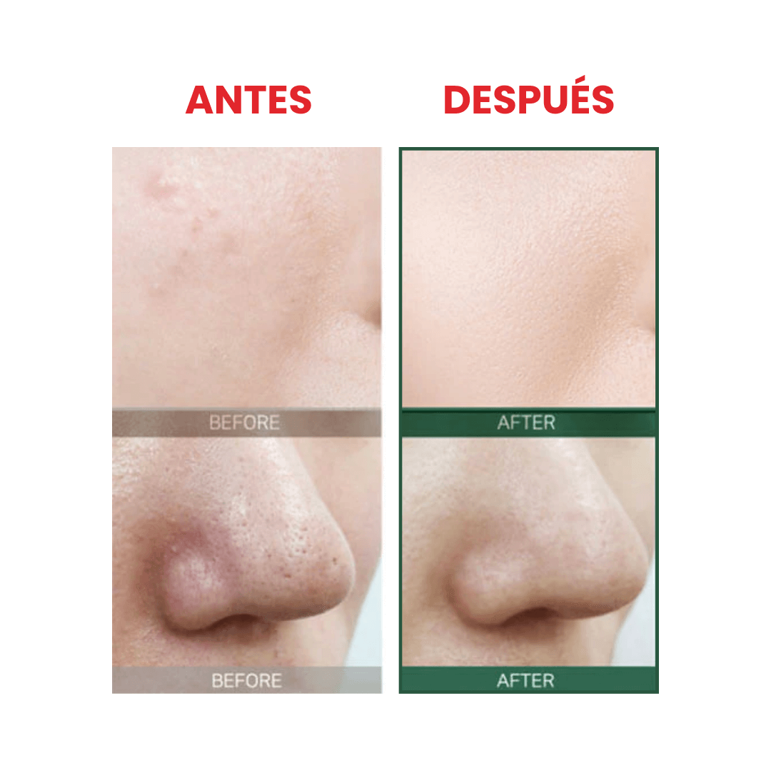 Tónico antiacné AHA-BHA-PHA 30 Days Miracle