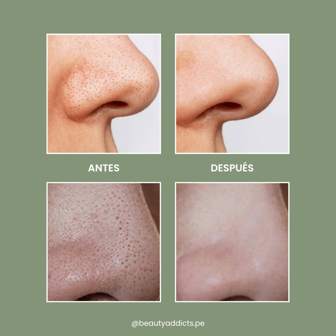 Beauty Addicts extractor de puntos que mejora visiblemente la piel con uso frecuente.