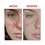 Ácido azelaico 10%  Azelaic acid suspension 10%