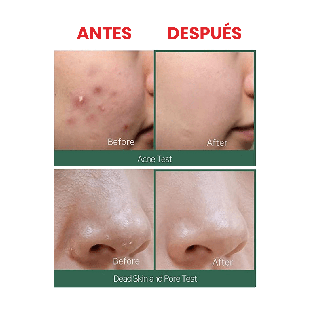 Crema hidratante antiacné AHA-BHA-PHA 30 Days Miracle