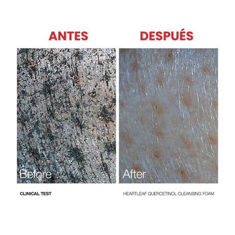 Antes y después de la doble limpieza de Anua. Combinación de aceite y espuma limpiadora.