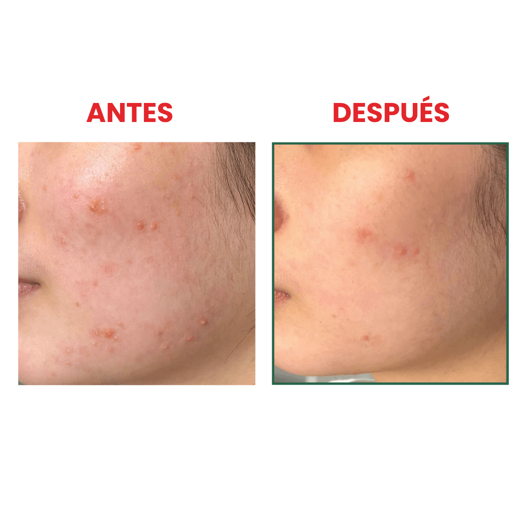 Espuma transparente para el acné AHA BHA PHA 30 Days Miracle