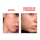 Antes y después del sérum facial de Anua con Niacinamida y TXA, diseñado para iluminar y unificar el tono de la piel mientras reduce imperfecciones.