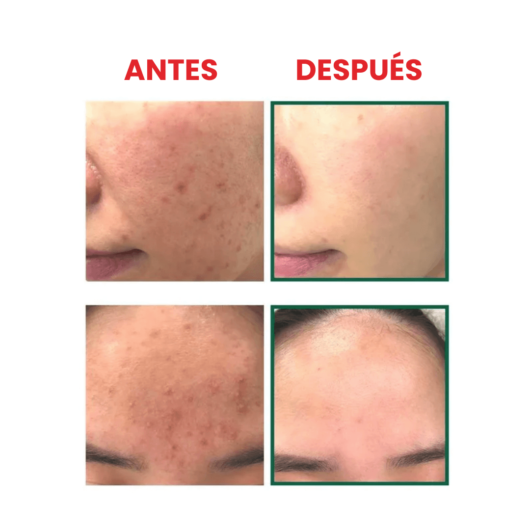 Serum antiacné AHA-BHA-PHA 30 Days Miracle