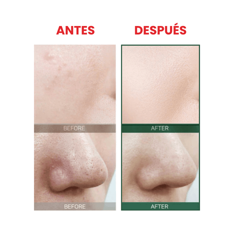 Some By Mi 30 Days Toner que reduce puntos negros y refina poros.