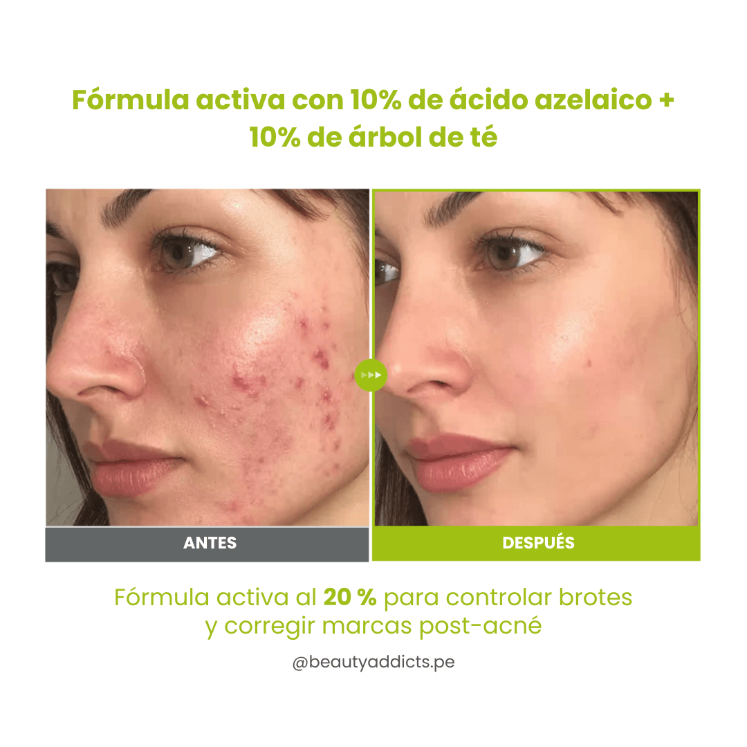 Azelaic Acid 10 Kojic Azulene Serum Purito SEOUL controla el acné y suaviza marcas postinflamatorias.