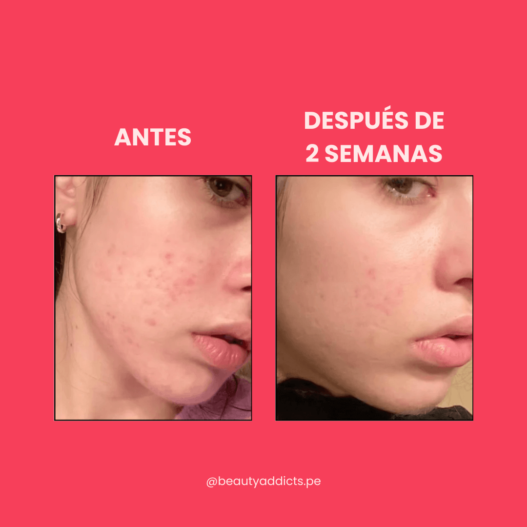 Antes y después del sérum facial de Anua con Niacinamida y TXA.
