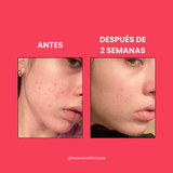 Antes y después del sérum facial de Anua con Niacinamida y TXA.