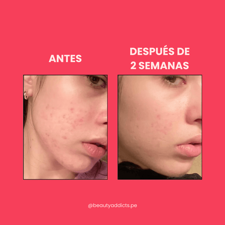 Serum ligero de Anua para las manchas: Niacinamide 10 % + TXA 4 % que calma rojeces y equilibra la piel sensible.