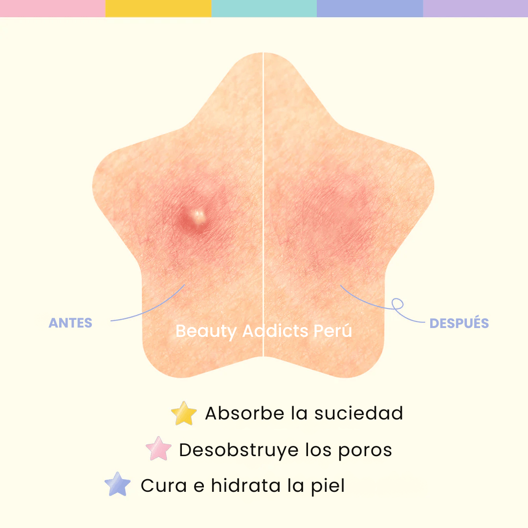 Star Spot Patch de OOTD ideales para cubrir imperfecciones y prevenir marcas post acné.